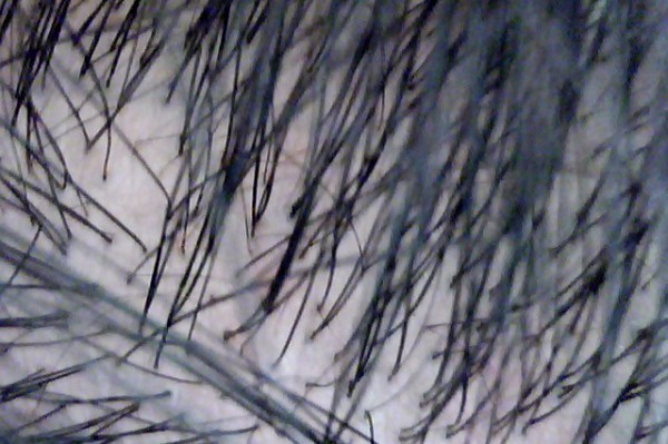 頭皮チェック 濃い所と薄い所 プロペシア効果 体験ブログ 3ヶ月で生えたホントの口コミや副作用レビュー